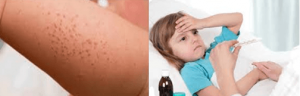 CHIKUNGUNYA SYMPTOMS IN CHILDREN: CAUSES, DIAGNOSIS AND PREVENTION