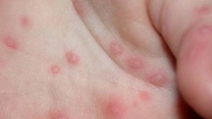 Skin Problems in Babies